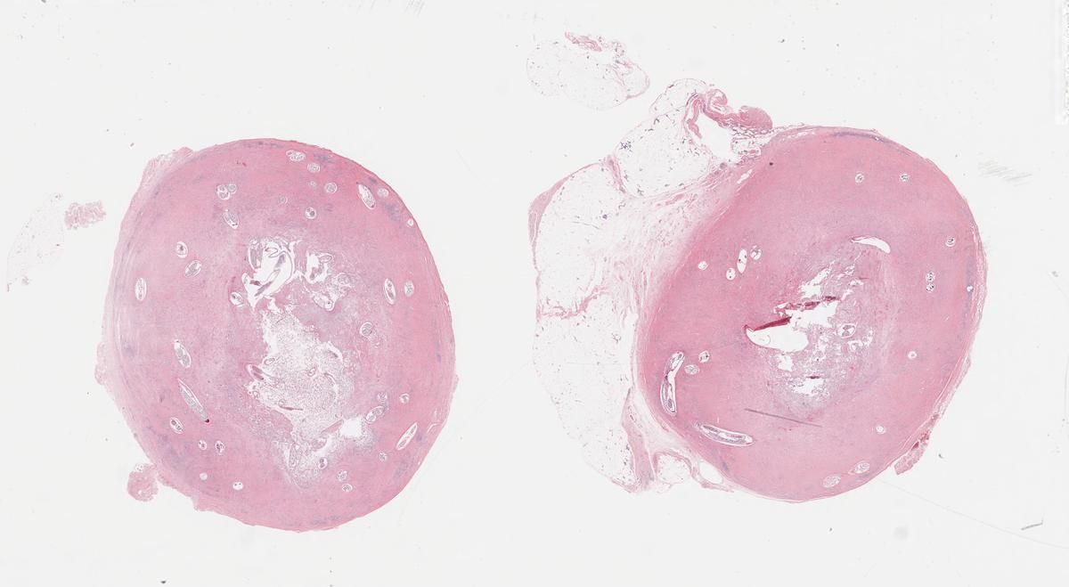 JMGardnerMD's tweet image. Soft tissue nodule. Can you diagnose it from one pic, or is it #TooLowToDiagnose?
Answer ✅ youtu.be/EPyakVOCmFs?si…
Digital slide: kikoxp.com/posts/51103
#pathology #pathTwitter #dermpath #dermatology #parasitology #dermatologia #dermtwitter