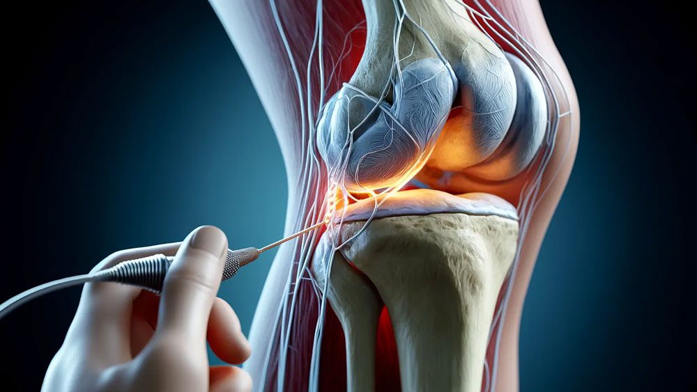 novusspine's tweet photo. Unlock lasting knee pain relief with genicular nerve radiofrequency ablation. Learn the benefits of this advanced pain management procedure for chronic knee pain. https://t.co/YCGJ59dNwB https://t.co/z2m8WDOwET