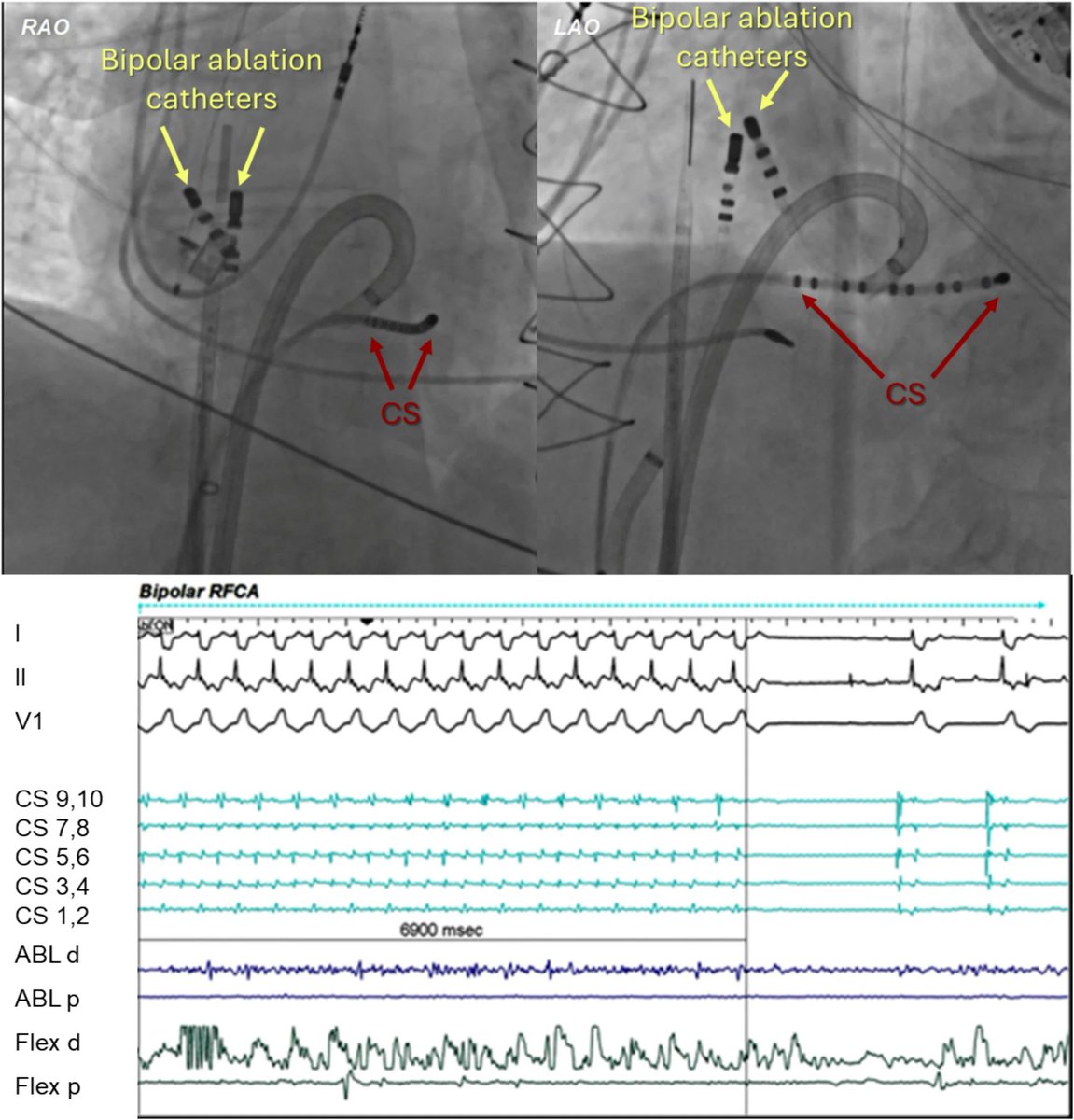 Piotr Futyma, MD (@ftrae) on Twitter photo Agree with Kevin. Here's our recent study where bipolar ablation was needed to complete the lesion in such circumstances link.springer.com/article/10.100… Agree with Kevin. Here's our recent study where bipolar ablation was needed to complete the lesion in such circumstances link.springer.com/article/10.100…