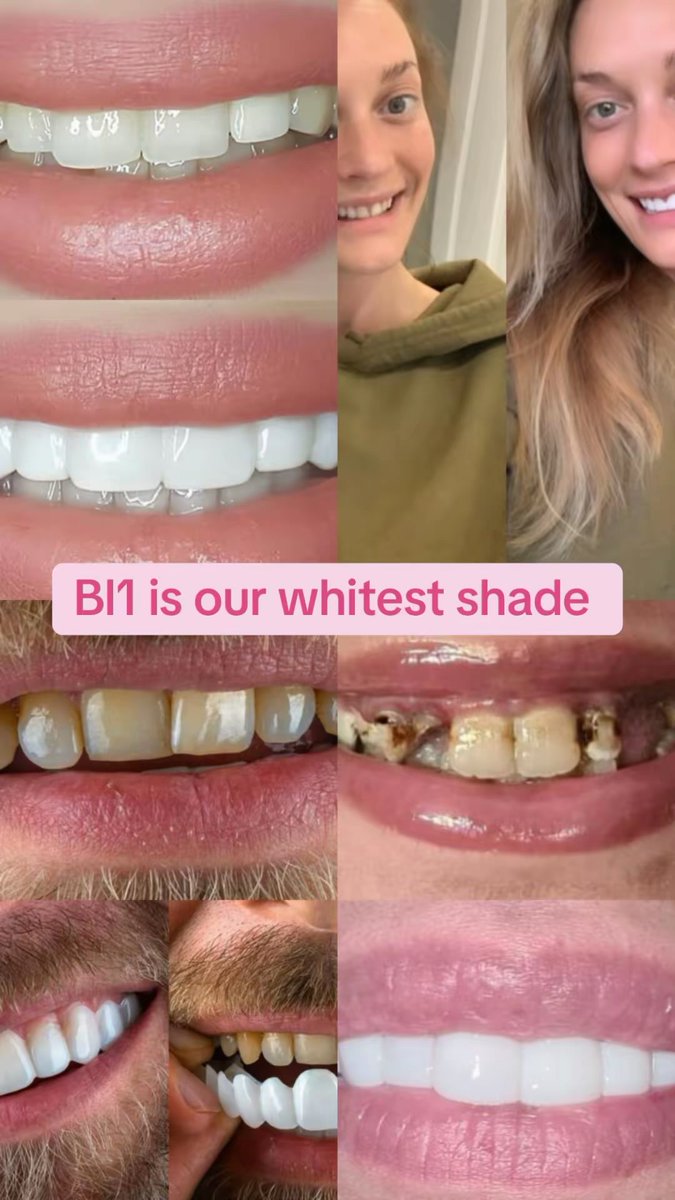 secretveneers's tweet photo. Shades explained! #secretveneers #teeth #clipinveneers #veneersuk https://t.co/9sbGCcDmvg