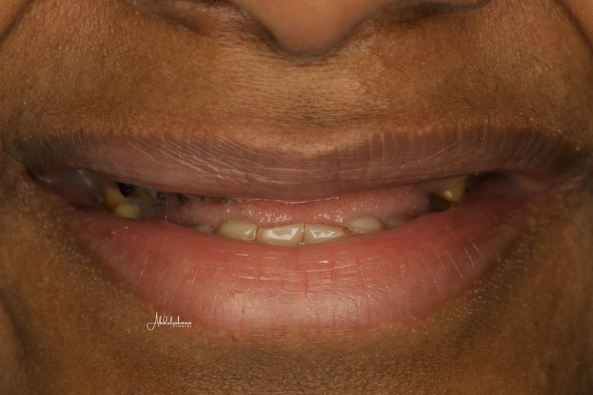 حالة اليوم لمراجع فقد الأسنان العلوية منذ فترة طويلة، مما أدى إلى ضمور في العظم وتدهور في العضة.

تم عمل تخطيط رقمي شامل لإعادة رفع العضة وتعويض #الأسنان المفقودة، مع زراعة عظم لإعادة بناء الدعم العظمي، تلاها #زراعة_أسنان أسنان فورية وتركيبات مؤقتة على الزراعة تحاكي شكل ووظيفة