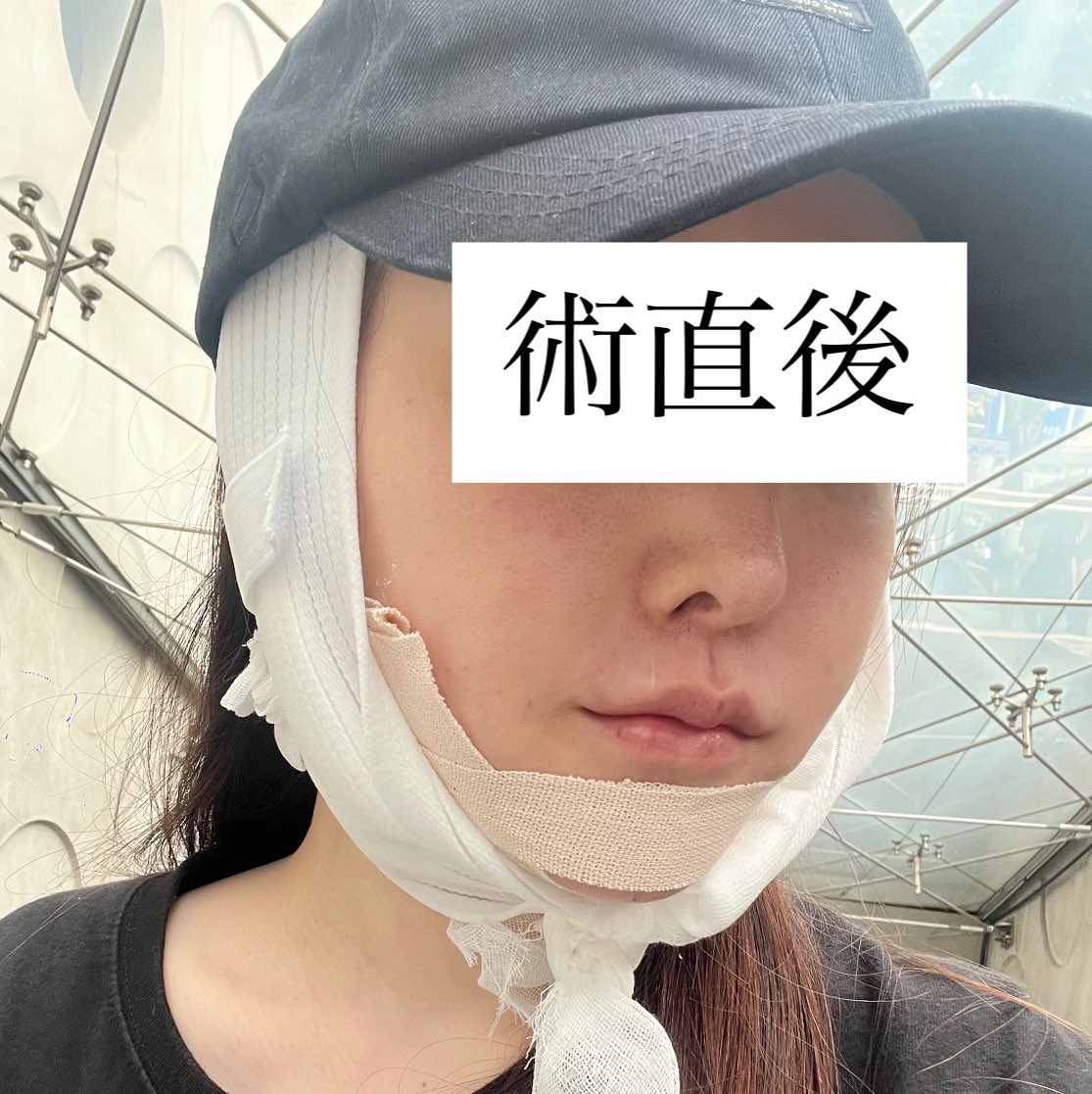 dr__kiya's tweet photo. ついに、ペリカン🇰🇷【顎下脂肪吸引（再）＋筋肉縛り＋深層脂肪除去＋皮膚切除】してきました！
顎の骨切り2度しているので皮膚の余りがあり、顎下脂肪吸引は1度しているので調整程度です。
オペ後から買い物やご飯も余裕でいけました🙆‍♀️痛みも腫れも全くありませんでした✨ https://t.co/J7TWgEVa6G