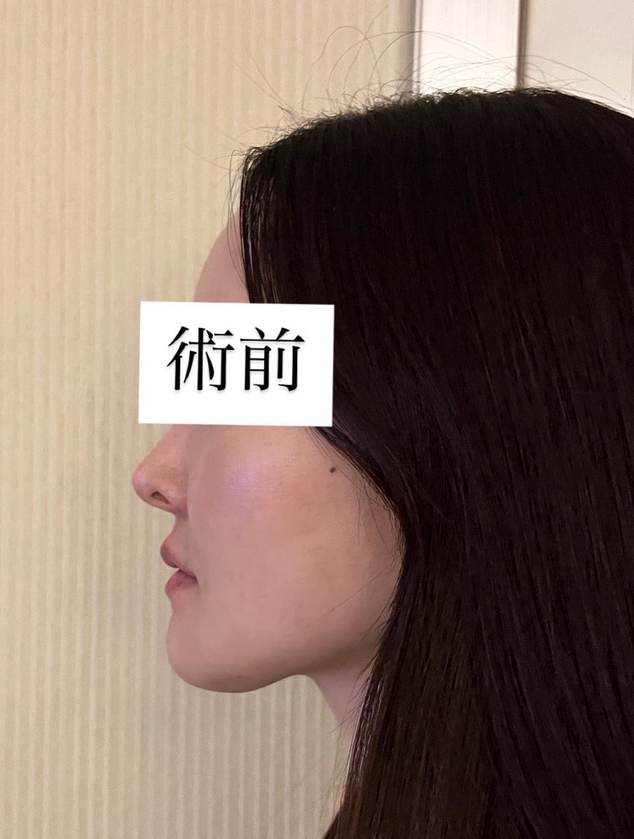 dr__kiya's tweet photo. ついに、ペリカン🇰🇷【顎下脂肪吸引（再）＋筋肉縛り＋深層脂肪除去＋皮膚切除】してきました！
顎の骨切り2度しているので皮膚の余りがあり、顎下脂肪吸引は1度しているので調整程度です。
オペ後から買い物やご飯も余裕でいけました🙆‍♀️痛みも腫れも全くありませんでした✨ https://t.co/J7TWgEVa6G