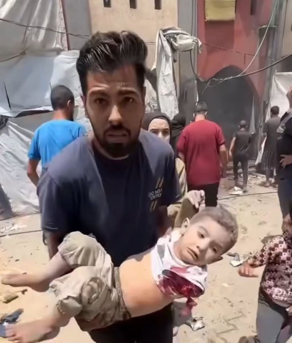 FurkanGozukara's tweet image. Yes what you see is a kid arm chopped of by Israel deliberately