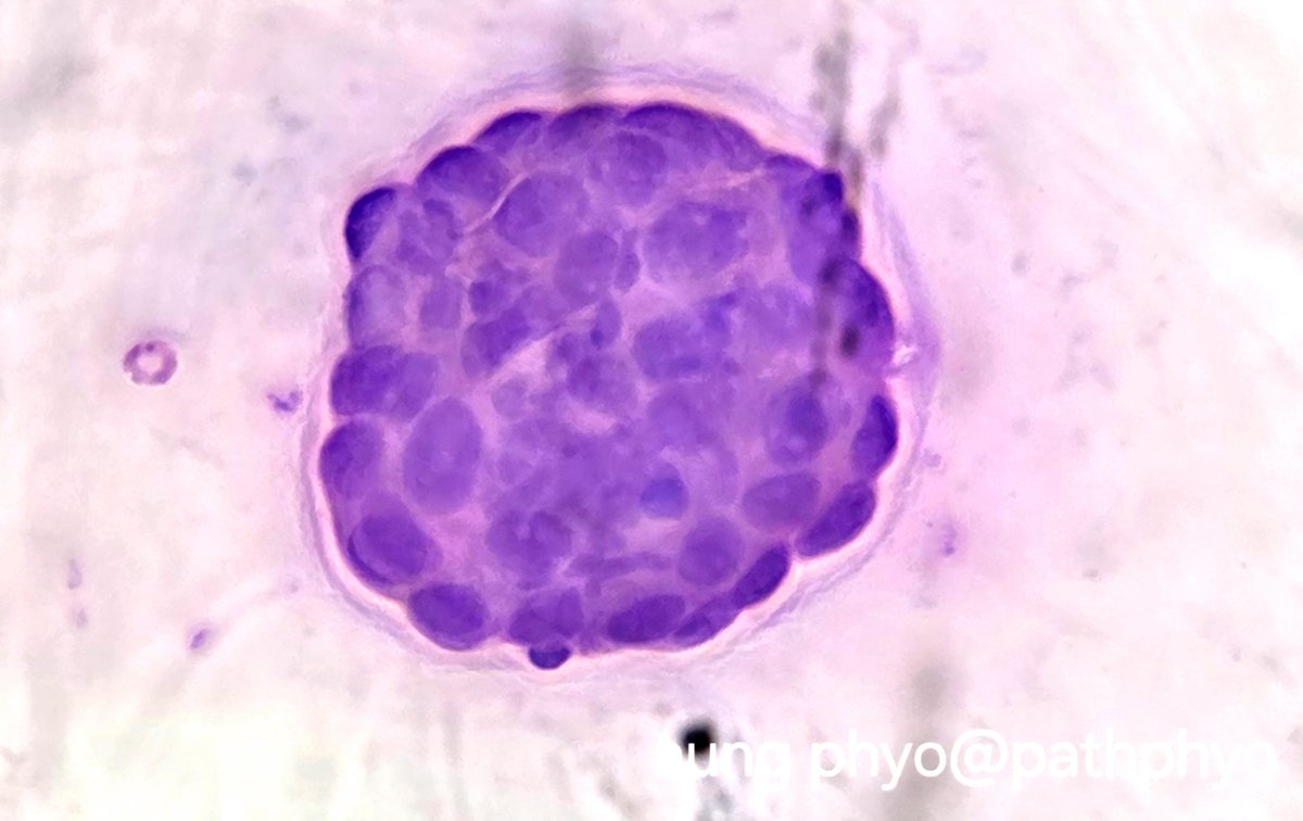 65 yrs old man with history of pulmonary adenocarcinoma with completed chemotherapy. Now presenting with left-sided pleural effusion. An unfortunate case of metastatic adenocarcinoma on pleural fluid cytology.
#pathology #cytopath #adenocarcinoma