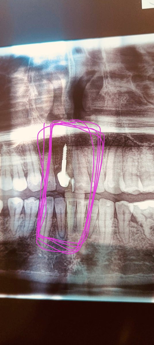 freimplant's tweet photo. Lesiones Endo óseas que provienen de la inserción de un “tornillo” inadecuado para el reemplazo de un diente, las consecuencias suelen ser nefastas dado que la extensión de la lesión provoca daños en las raíces vecínas y en el antagonista. https://t.co/cYfx6FGDg9