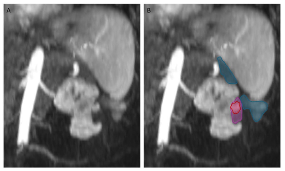 Beau Bosko Toskich, MD FSIR tweet media