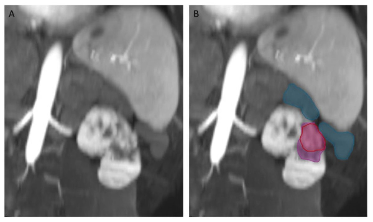Beau Bosko Toskich, MD FSIR tweet media
