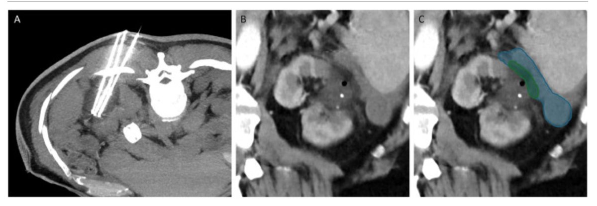 Beau Bosko Toskich, MD FSIR tweet media