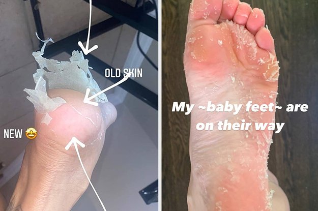 BabyFootUSA's tweet photo. Do you Foot Peel? https://t.co/NlKWcDK6gI