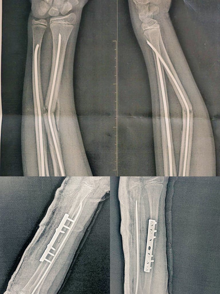 Mohamed Sabri 🇦🇹🏹🤍 (@mohamed01430791) on Twitter photo Male pt 13 yrs metal Failure Mid Shaft Radius history of BBFA fixed by ender 1.5 y ago »»»
Ender removal and fixation of the fracture by small DCP
By thomspon approach ⚔️🥷🤍.... Male pt 13 yrs metal Failure Mid Shaft Radius history of BBFA fixed by ender 1.5 y ago »»»
Ender removal and fixation of the fracture by small DCP
By thomspon approach ⚔️🥷🤍....