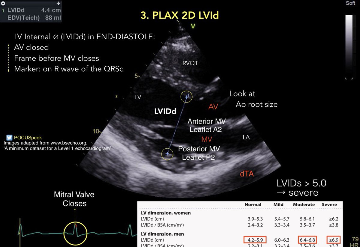 🔍 Parasternal Long Axis (PLAX) View – vital for assessing LV function, valvular pathology, and effusions in dyspneic/shock patients; meta-analyses show 85-95% accuracy for EF estimation vs echo

Expert annotated PLAX image 👇

Acquire PLAX like a pro! youtube.com/watch?v=2b0I2D…

⚡