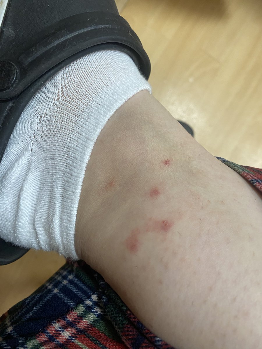 <a href="/PelinUar850691/">Pein</a> her gece daha fazla ısırıyor uyuyamıyoruz