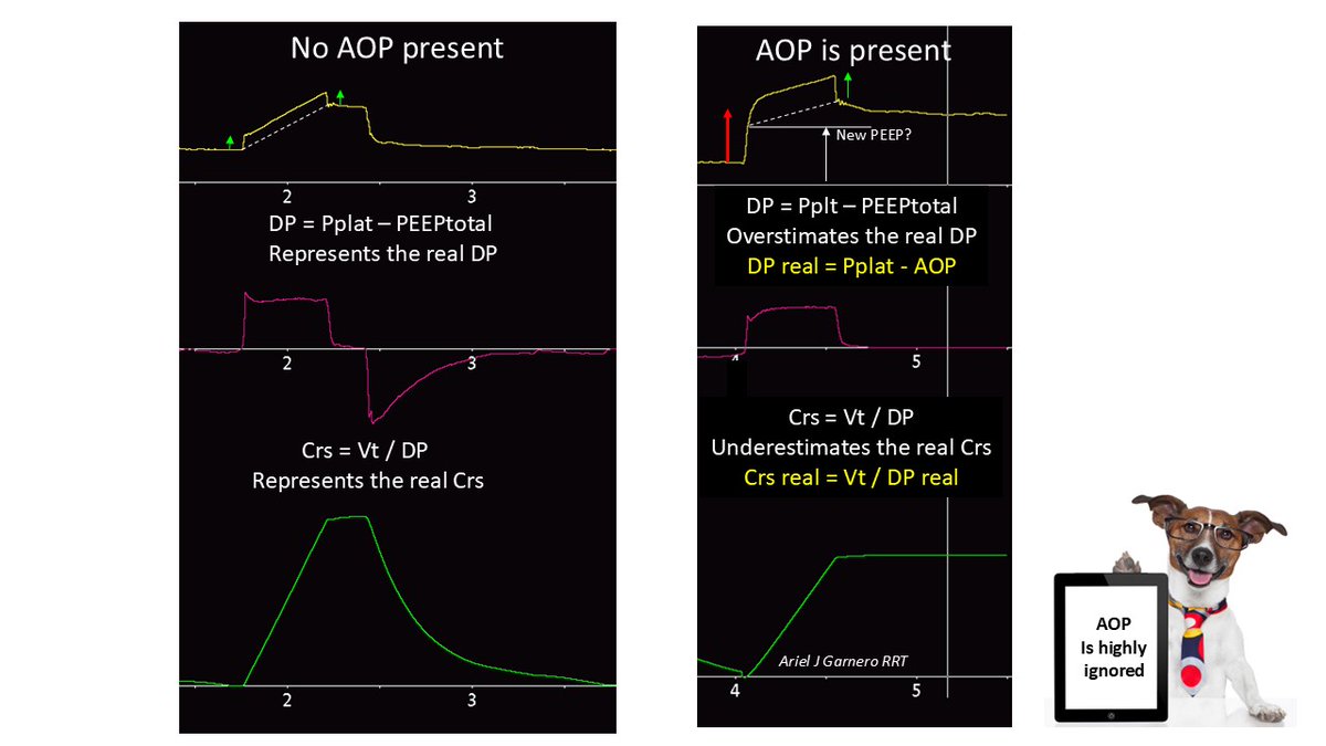 Ariel J Garnero (@arielg_rrt) on Twitter photo AOP is a frequently overlooked phenomenon that can mislead our decisions. It may be suspected during normal ventilation using the P conductive method Where would you adjust PEEP based on your observations? What is your reasoning? How would the graphic change after the new PEEP? AOP is a frequently overlooked phenomenon that can mislead our decisions. It may be suspected during normal ventilation using the P conductive method Where would you adjust PEEP based on your observations? What is your reasoning? How would the graphic change after the new PEEP?