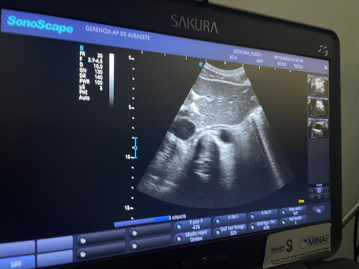 📢 Sábado... y seguimos!!!  Formación en #Ecografía en AP del <a href="/sescamclm/">SESCAM</a>
👇
📌 Curso Básico para Enfermería y Curso Avanzado para Medicina en el CS Zona IV y Hospital Perpetuo Socorro de #Albacete
📌 Curso Avanzado para Medicina en el Hospital de Almansa 👏👏 <a href="/SCAMFYC/">🆂🅲🅰🅼🅵🆈🅲</a> 
#POCUS