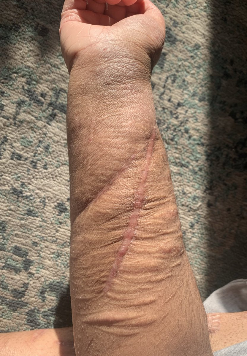 scaledsolace's tweet photo. dry arms 
#自残 #shtwt https://t.co/TzdlPdPuO7