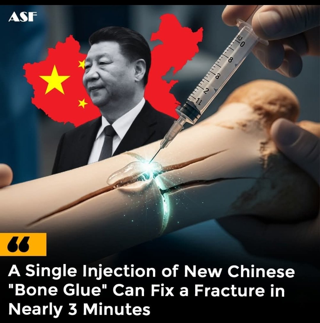 RobertoRussia's tweet image. Cientistas na China introduziram o Bone-02, uma nova “cola óssea” inspirada na aderência da ostra, que pode supostamente reparar fraturas em três minutos usando uma única injeção. Relatórios iniciais citam testes em mais de 150 pacientes, mostrando forte ligação e absorção
🧵👇🏻👇🏻