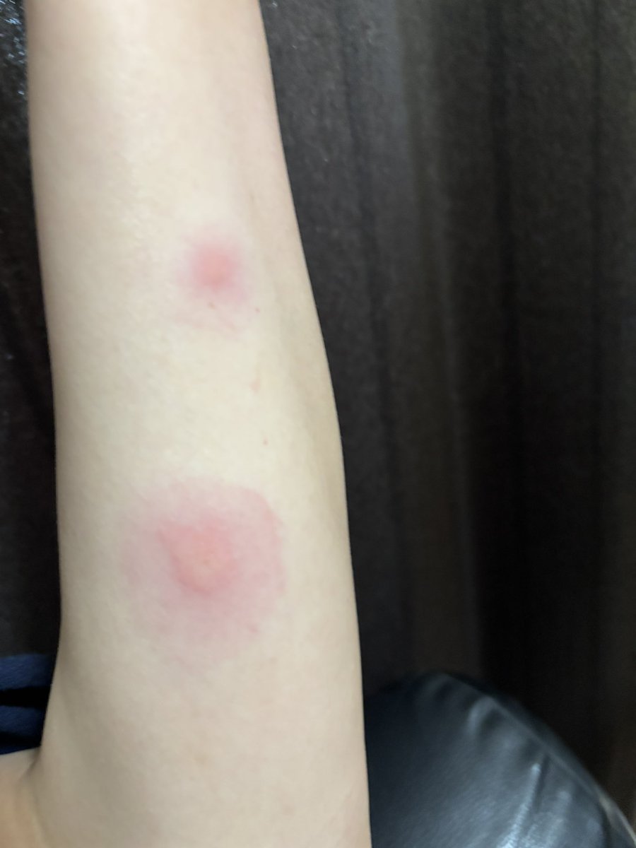 kg10m's tweet photo. 虫刺されでこんなんなるのすごい嫌
かゆいし明日にはもっと赤くなるんだけどなに https://t.co/vAxATXMgMw