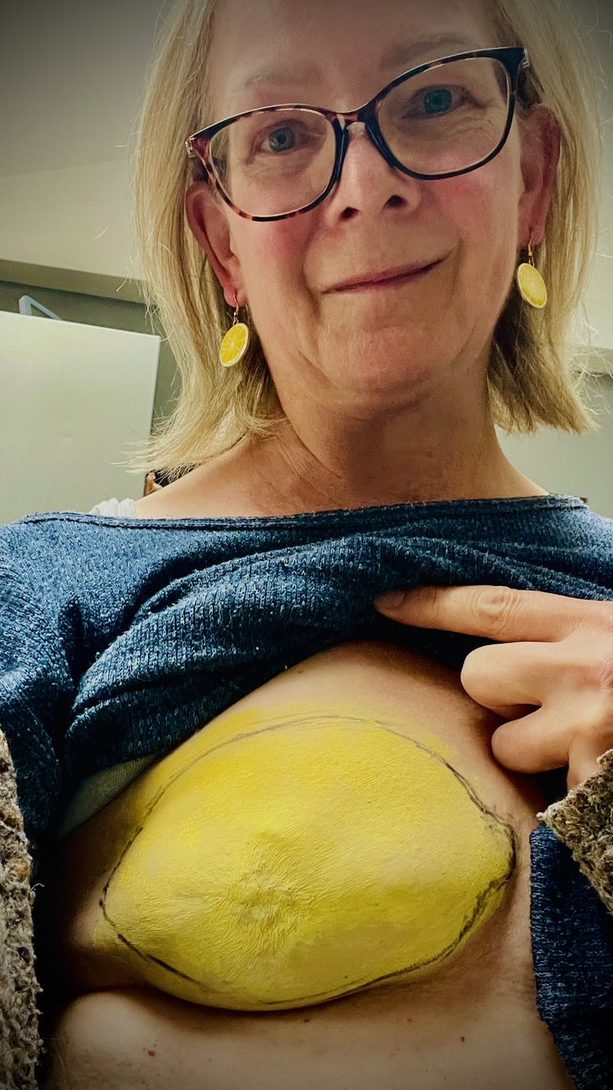 When life gives you lemons 🍋 

My skin sparing mastectomy 6 year anniversary in honour of #BreastCancer awareness. 

Keep checking yourselves gang 🙏🏻

<a href="/BreastCancerNow/">Breast Cancer Now</a> <a href="/BreastCancerCCS/">A Future Without Breast Cancer</a> 
<a href="/macmillancancer/">Macmillan Cancer Support</a> <a href="/CR_UK/">Cancer Research UK</a> <a href="/SU2CUK/">Stand Up To Cancer UK</a>