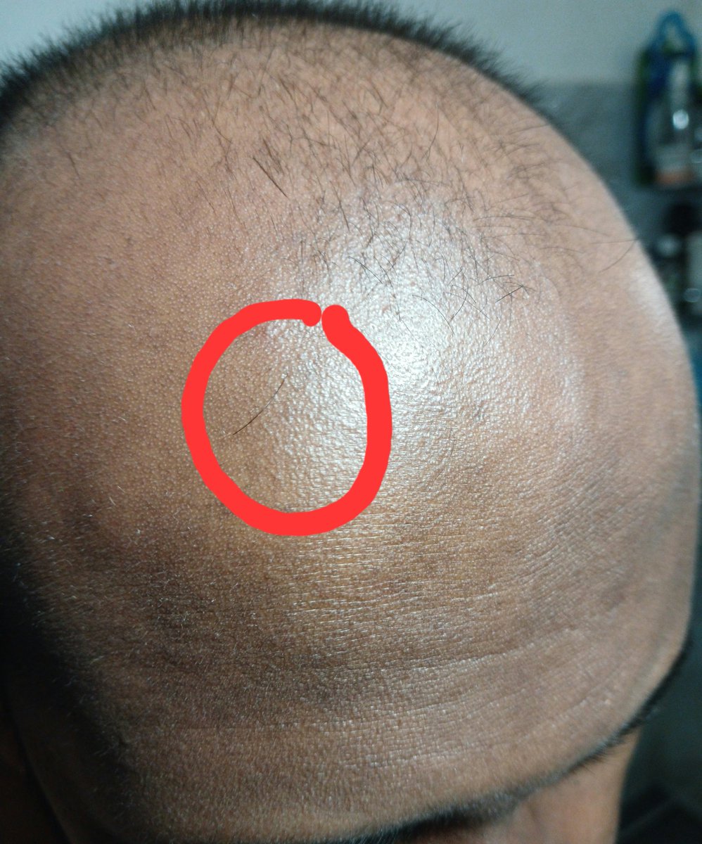 I started going bald when I was just 19, and it was a tough thing to face at that age.
Today, it’s funny to see a few strands still refusing to give up on me,
I embraced the new haircut and this new normal long ago.