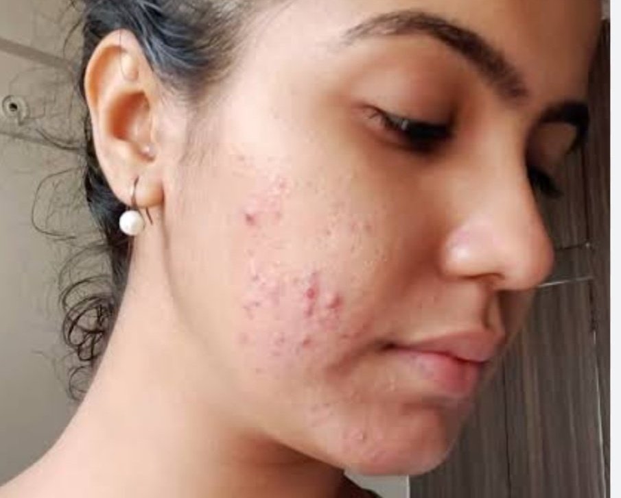 दोस्तों मेरे पिंपल ठीक नहीं हो रहे हैं क्या करूं? 

कोई सुझाव हो तो बताइए। 😢