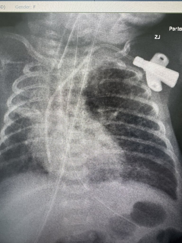 Thuaimer's tweet photo. Even the smallest lives deserve the biggest precision.
Successfully secured a central line for a preterm neonate — just 24 weeks, 650 grams. 💉👶✨
This remind us: every gram matters, every heartbeat counts, and every effort is worth it. 💪❤️
#Irad #PedsIR #TinyFighters #IVAccess https://t.co/1nrHkzuKgL