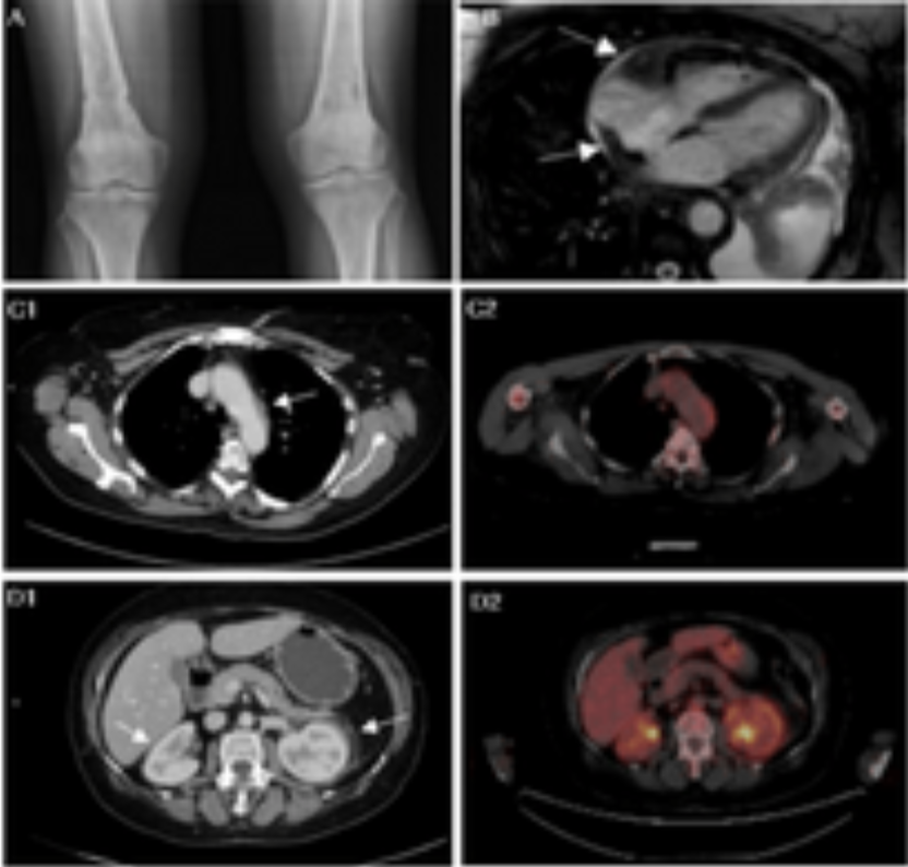 Images_Case's tweet photo. Combined Treatment with Vemurafenib and Cobimetinib in Langerhans Cell Histiocytosis and Erdheim-Chester Disease Overlap Syndrome: A Case Report: Histiocytoses are clonal disorders diseases derived from the monocyte-macrophage lineage.
https://t.co/i7xzMpvgpH https://t.co/NvX7dvN4WA
