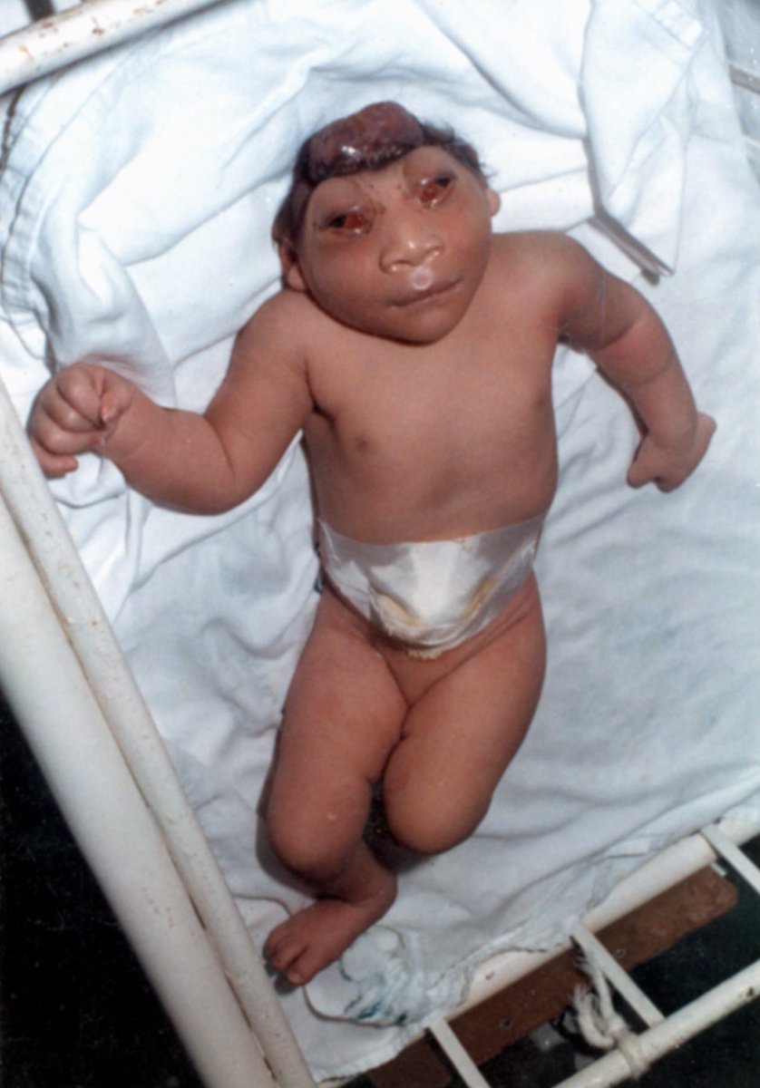 <a href="/TrackYourHeart/">CardiovascularCorner</a> #embriologio , #estudiamedicina, #Enarm, #Mir26
A:
Anencefalia. Defecto de tubo neural. Aprox. 1/8000 nacidos.