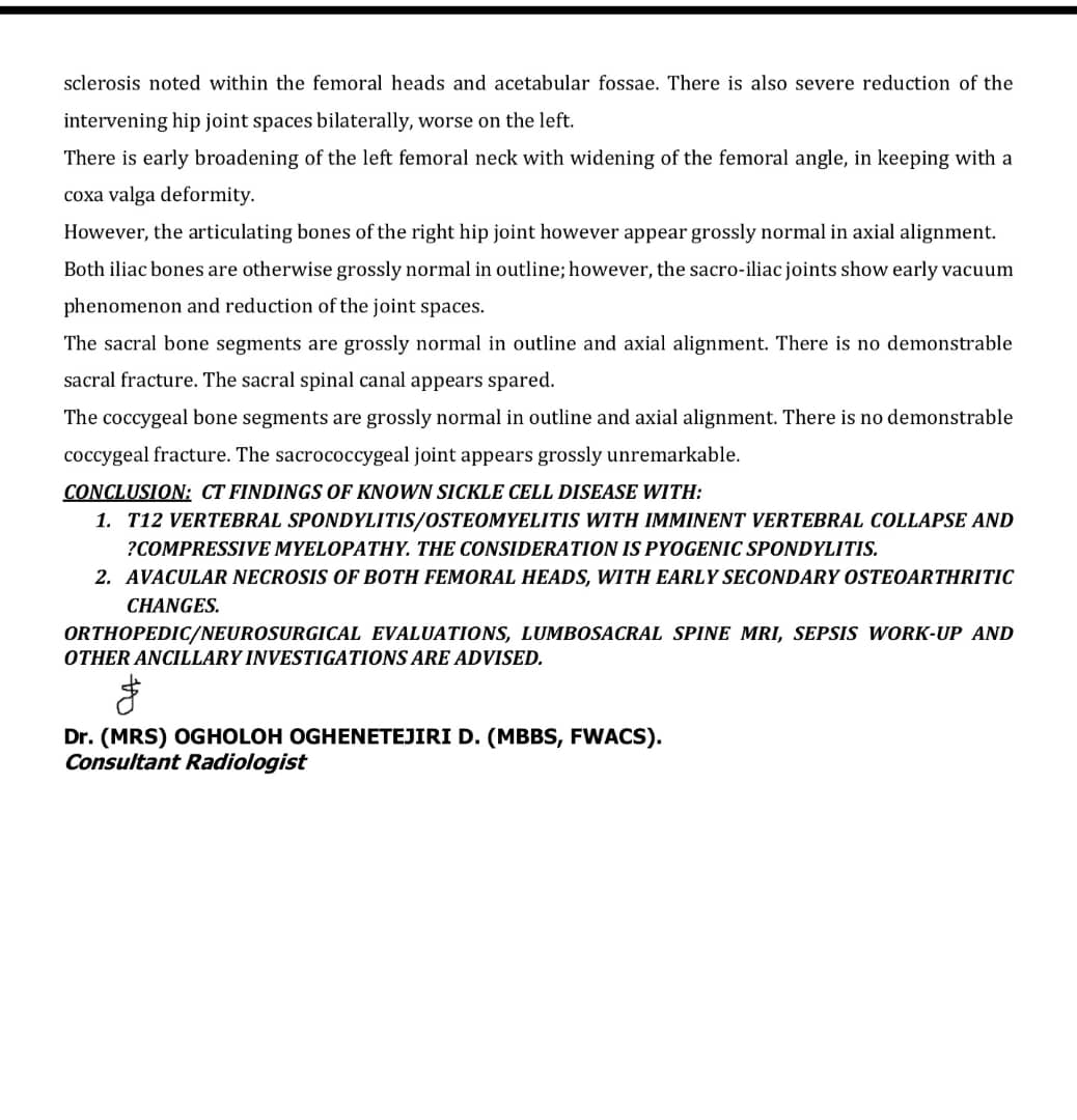 jola_adey's tweet photo. 🚨 HELP SAVE A LIFE 🚨

We are still soliciting for funds, nothing is too small 🙏
Please, help me save my brother’s life.

He urgently needs a bilateral hip replacement due to Avascular Necrosis of both hips and Spinal Osteomyelitis.

💰 Cost: ₦6m
✅ Amount raised: ₦1.5m+ https://t.co/OiscoE835Z