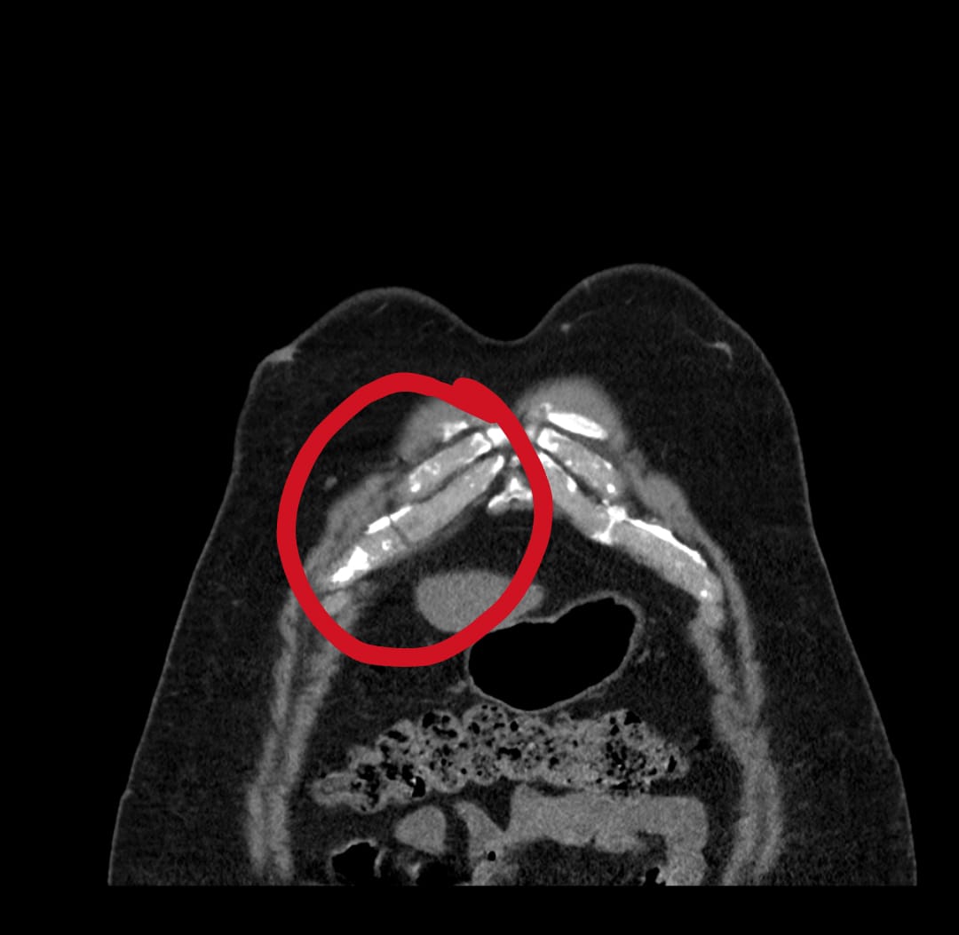 Dr_Hakim_FRCR's tweet photo. Two different patients
7 days apart
Same side
Same costal cartilage
Right 7th costal cartilage fracture
#Trauma #ER #MedEd #medx #radres #radiology #ERRad #Errad #CT #CHEST https://t.co/4AmmRhPbCb