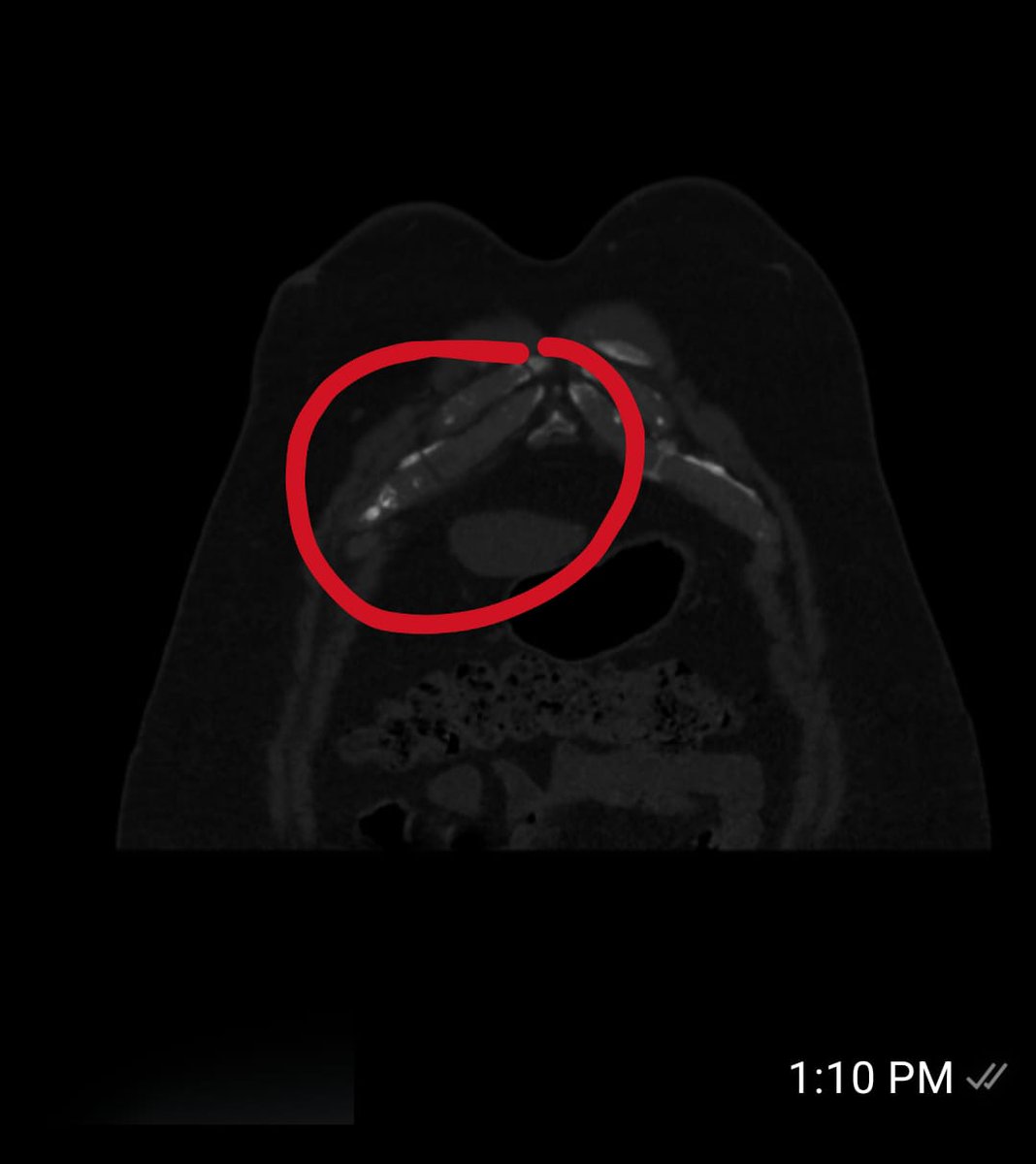 Dr_Hakim_FRCR's tweet photo. Two different patients
7 days apart
Same side
Same costal cartilage
Right 7th costal cartilage fracture
#Trauma #ER #MedEd #medx #radres #radiology #ERRad #Errad #CT #CHEST https://t.co/4AmmRhPbCb