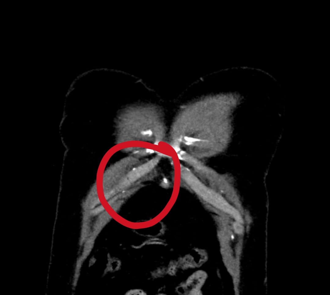 Dr_Hakim_FRCR's tweet photo. Two different patients
7 days apart
Same side
Same costal cartilage
Right 7th costal cartilage fracture
#Trauma #ER #MedEd #medx #radres #radiology #ERRad #Errad #CT #CHEST https://t.co/4AmmRhPbCb
