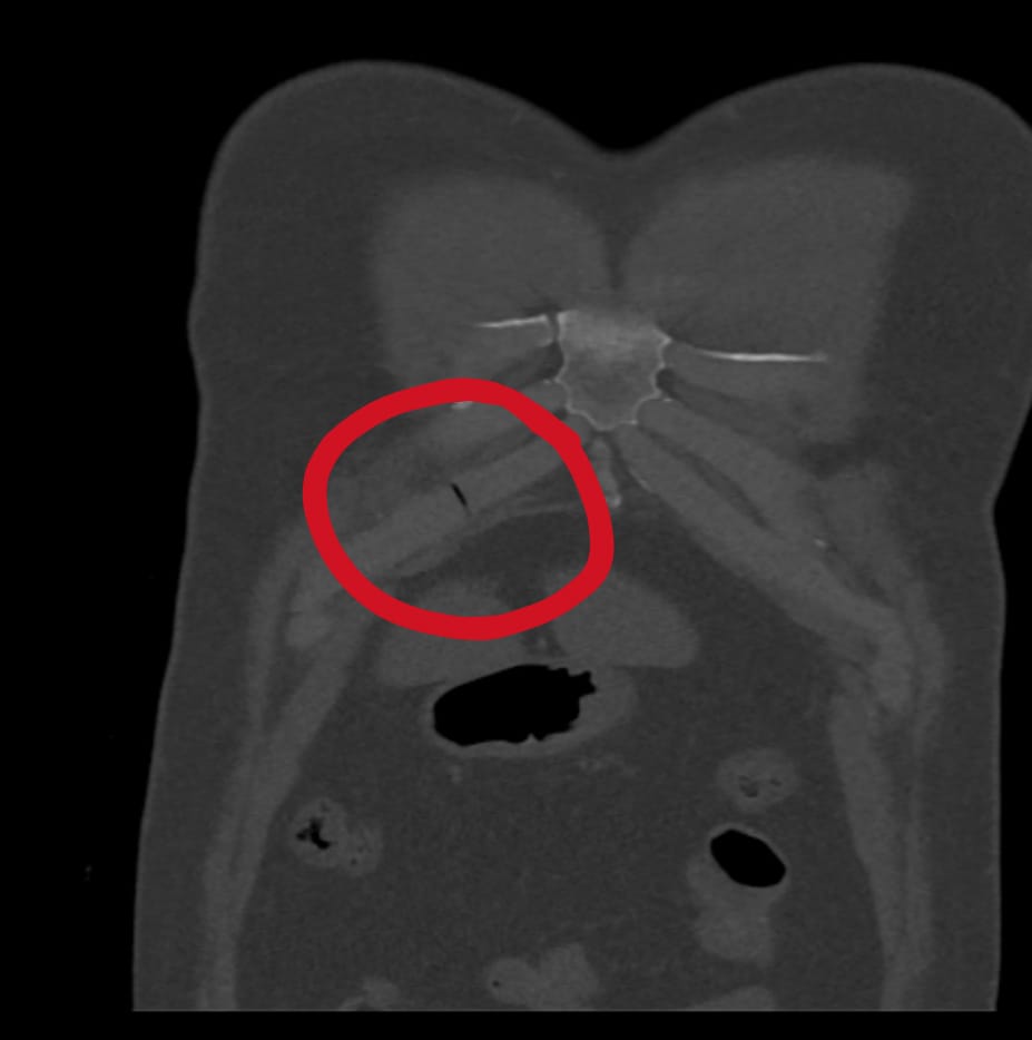 Dr_Hakim_FRCR's tweet photo. Two different patients
7 days apart
Same side
Same costal cartilage
Right 7th costal cartilage fracture
#Trauma #ER #MedEd #medx #radres #radiology #ERRad #Errad #CT #CHEST https://t.co/4AmmRhPbCb