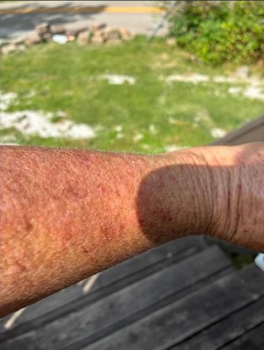 When some WV coalfield residents shower it burns their skin. When will safe public water be considered a "critical service?" #waterforwv