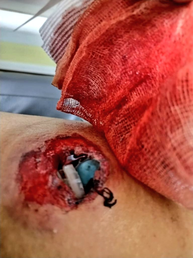 #Urgente #ImagenSensible Los médicos que han atendido a RUMI han confirmado que su herida ha sido causada por un perdigón esférico de plomo llamado POSTA, que tiene más de 5mm de diametro. Su uso está prohibido desde 2003, pero la Polizia Nazional de #DinaAsesina lo está usando