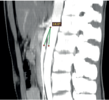 Wilkie’s Syndrome may be rare—but deadly if missed. ⚠️

When the aorto-mesenteric angle narrows, it can compress the duodenum, blocking digestion and risking fatal complications.

Early CT or MRI angiography can save lives through timely surgery.

Read more here: