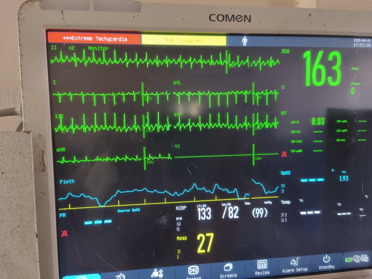 ASMXLR8's tweet photo. @ecgandrhythmRoe How about this. 24 yrs  G3 presnted with sob and desaturate to level of 81 of oxygen. No last medical hx. Cxr attached below https://t.co/U5pgMXMWzW