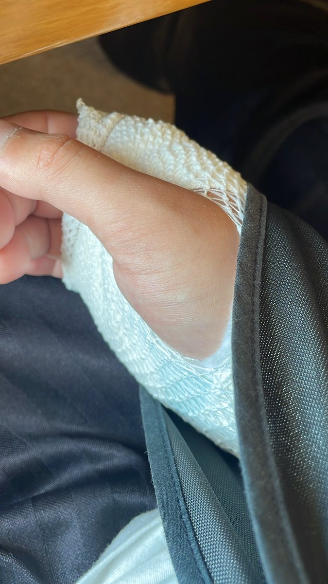 ka_tabemono's tweet photo. 利き手の右腕骨折全治2ヶ月…
しばらくおにぎり生活となります😭
大好きな車も禁止され辛いです。。。 https://t.co/vBVaKEB1Lt