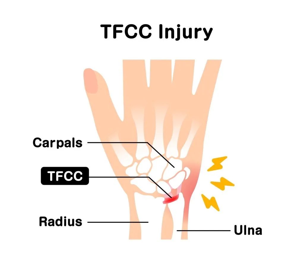 خلونا نتكلم بشكل مبسط عن:
Triangular Fibrocartilage Complex injuries