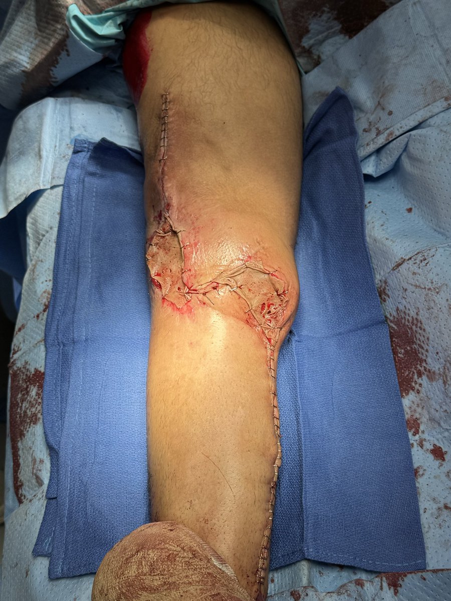 DRodUTOrtho's tweet photo. One at a time. Im Gods hands now.  D Hopkins master surgeon. #UTOrtho https://t.co/dLJHEsj6Ko