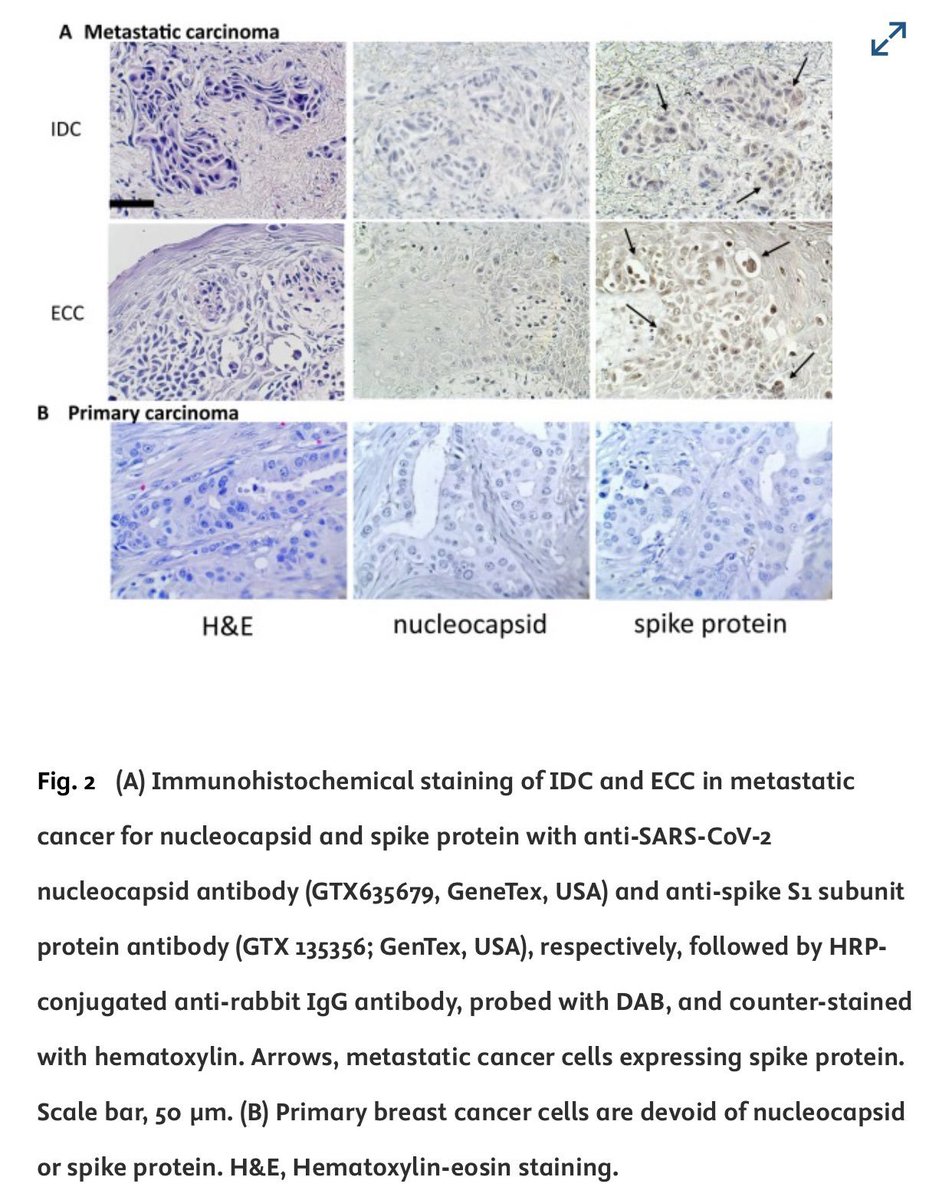 VaccineMole's tweet image. Update: Thanks to @d8OJM63EMtss8BN for sharing details with figure legends confirming the findings:
Fig. 2 shows IHC staining of metastatic breast cancer in skin (A: IDC &amp;amp; ECC) vs. primary tumor (B). H&amp;amp;E reveals morphology and as mentioned in the main post, nucleocapsid is…
