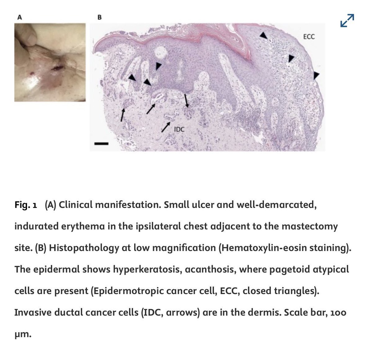 VaccineMole's tweet image. Update: Thanks to @d8OJM63EMtss8BN for sharing details with figure legends confirming the findings:
Fig. 2 shows IHC staining of metastatic breast cancer in skin (A: IDC &amp;amp; ECC) vs. primary tumor (B). H&amp;amp;E reveals morphology and as mentioned in the main post, nucleocapsid is…