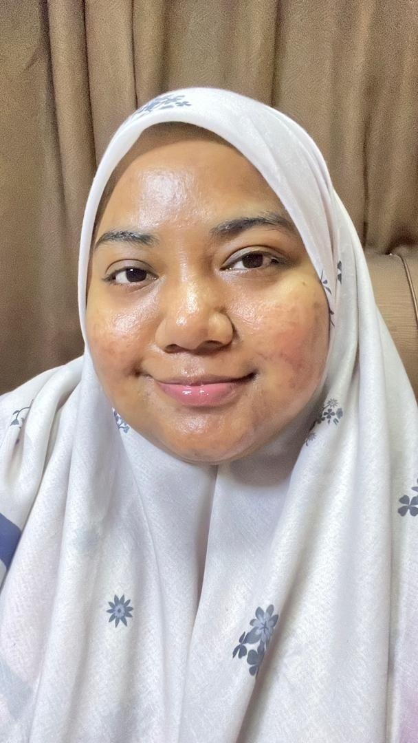 ByKimKaylaa_'s tweet photo. Agak terkejut sebenarnya, sebab pakai satu products ni je, baru seminggu weyh, tapi skin i banyak sangat improvement dah. Parut degil yang susah sangat nak hilang, memang slowly pudar dah, walaupun masih banyak lagi bekas but i dah cukup puas hati dengan hasil ni. https://t.co/jV4eXDw3aO