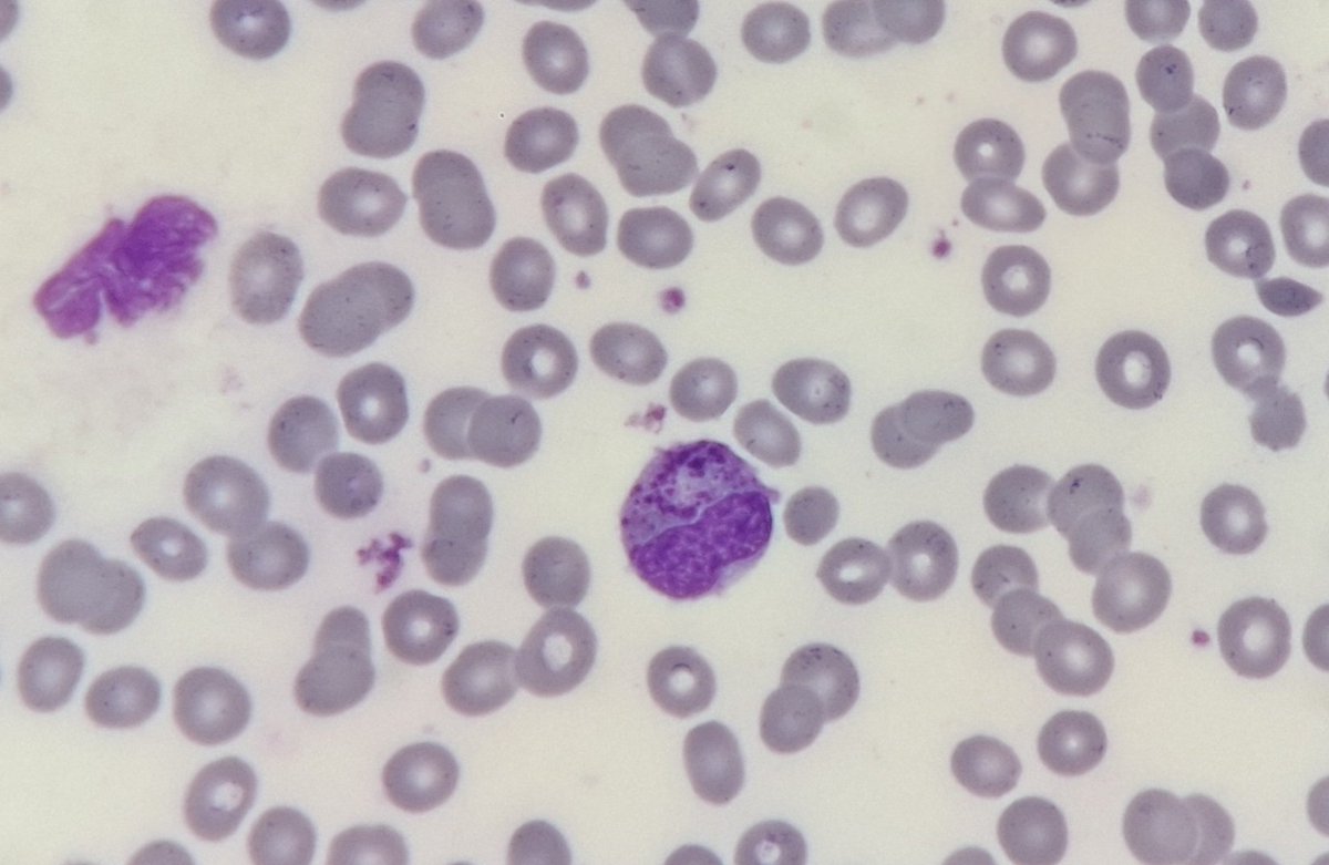 JesienMarcin's tweet photo. Bone marrow aspiration.
54 yo man.
WBC 24×10^3
RBC 2,36×10^6
HGB 7,4 g/dl
PLT 11×10^3
#onlycells
#hemepath https://t.co/zXrSMS8Rsl