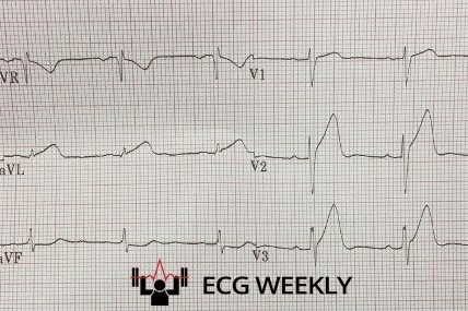 A 28 yo f, postpartum, calls 911 for acute chest pressure. Paramedics obtain the following prehospital ECG that the computer interprets as “nonspecific ST abnormalities” the patient waits in the hallway for 30 minutes before anyone recognizes..... rebrand.ly/bob3si5