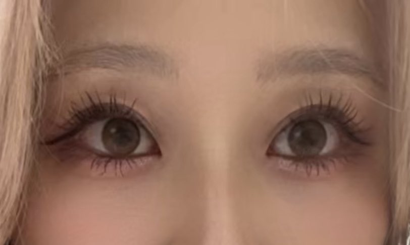 guruma_chan's tweet photo. 埋没　クマ取り　3年経過🥺
#クマケアクリニック
#下眼瞼脱脂
#埋没 https://t.co/kWGszyZTQB