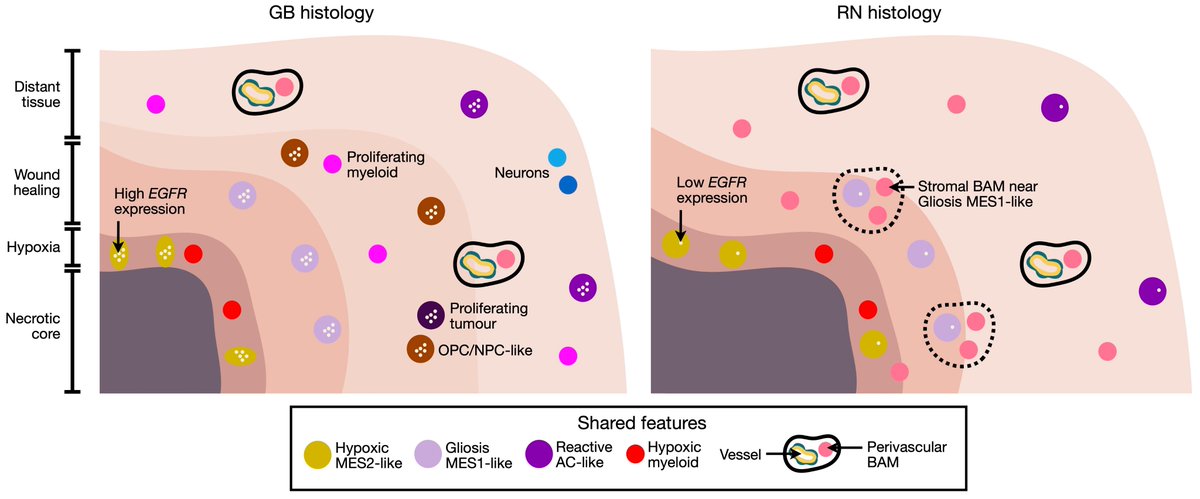 🚨new pre-print alert 

we present the first spatially resolved single cell atlas comparing radionecrotic changes (RN) and recurrent IDH-wildtype glioblastoma (GB) – shedding light on a long-standing diagnostic challenge. 

🧵 1/