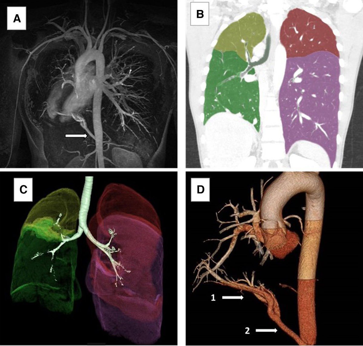 📷 This is the new clinical image: Rare Association of Right Upper Lobe Agenesis, Dextrocardia, and Aberrant Hepatic Arterial Supply. 

Discover more about this phenomenon in #ArchivosdeBronconeumología

🔗 Access here: n9.cl/edqqo

#SEPAR
