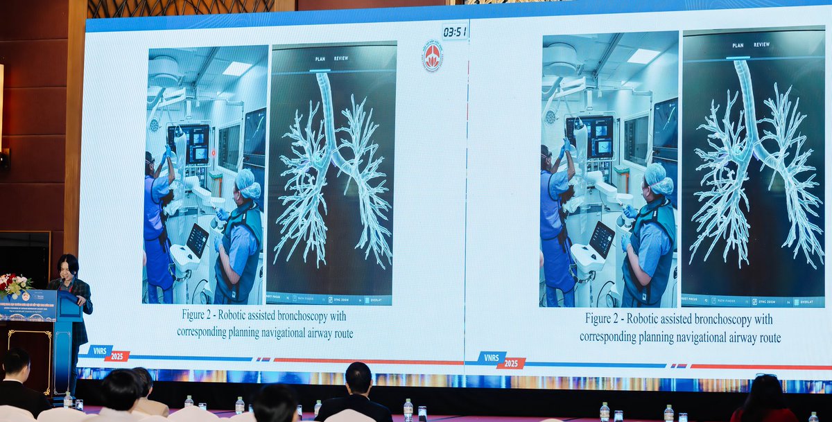 ADL_IPPG (@adl_ippg) on Twitter photo More from the Annual Congress of Vietnam Respiratory Society 2025! Discussions on EBUS and Robots. #respiratory #interventionalpulmonology #medicine #bronchoscopy #lungcancer More from the Annual Congress of Vietnam Respiratory Society 2025! Discussions on EBUS and Robots. #respiratory #interventionalpulmonology #medicine #bronchoscopy #lungcancer