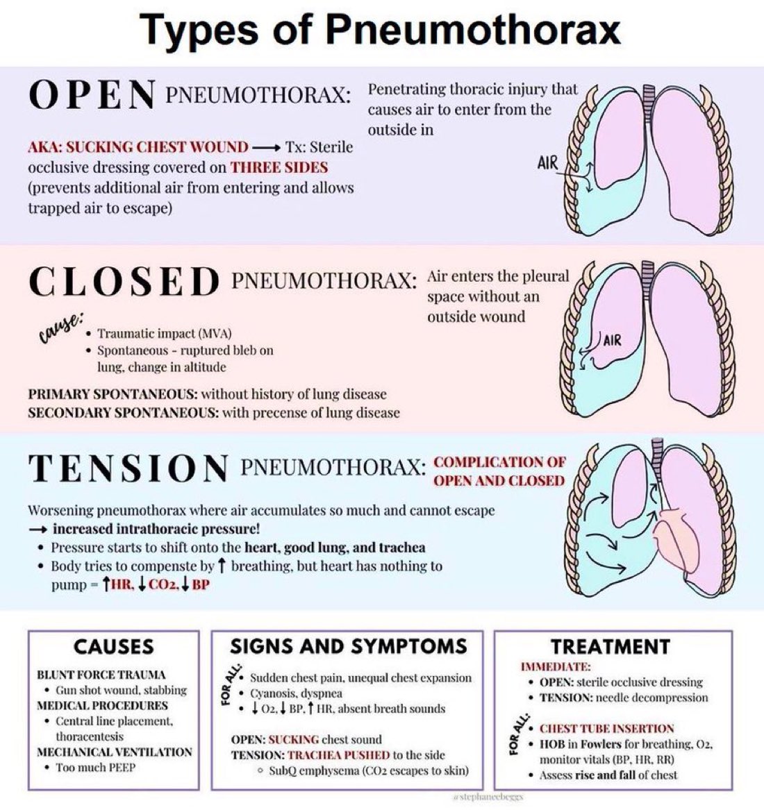 doctors_squad's tweet photo. Types of Pneumothorax https://t.co/klzDGQUIKq